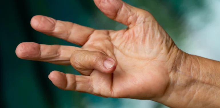 Physiotherapist providing trigger finger physiotherapy treatment at home in Karachi